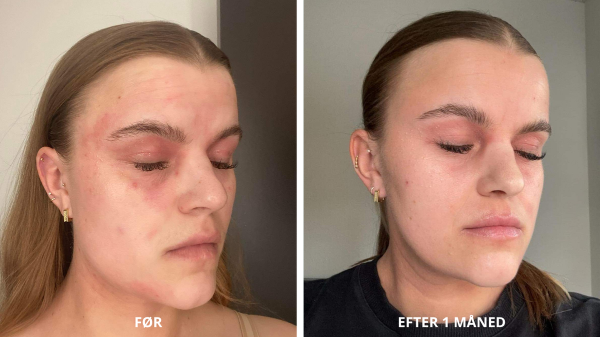 Vorher und nachher: Emmas Erfahrung mit NatureCell CBD Hautpflege