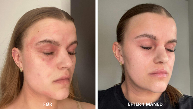 Før og efter: Emmas oplevelse med NatureCell CBD hudpleje