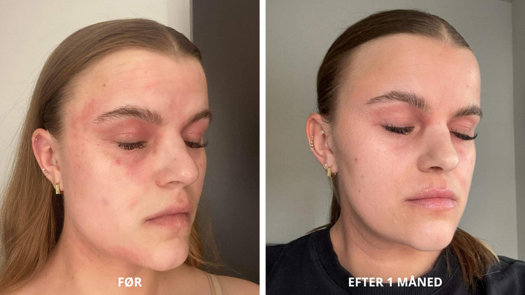 Før og efter: Emmas oplevelse med NatureCell CBD hudpleje