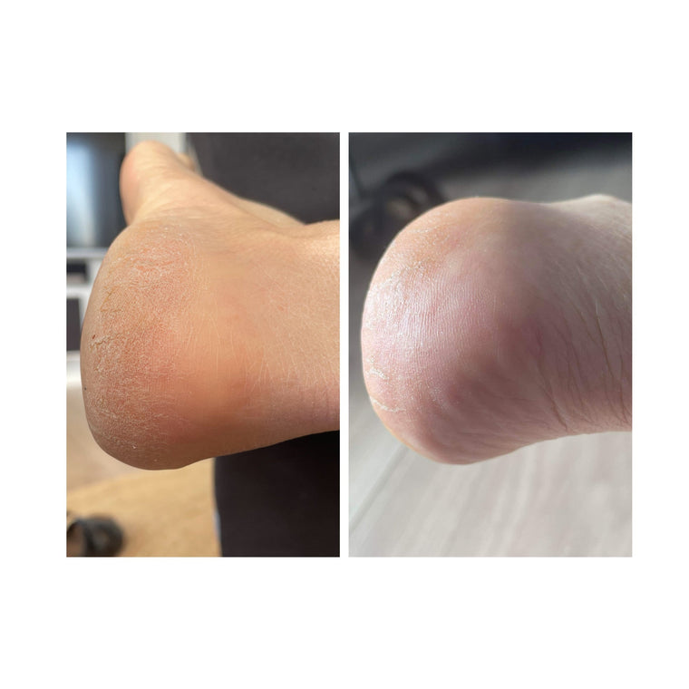 Heidis oplevelse med pleje af tørre hæle - CBD Fodcreme